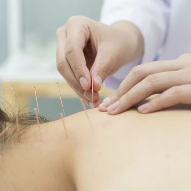 acupuncture for neck pain